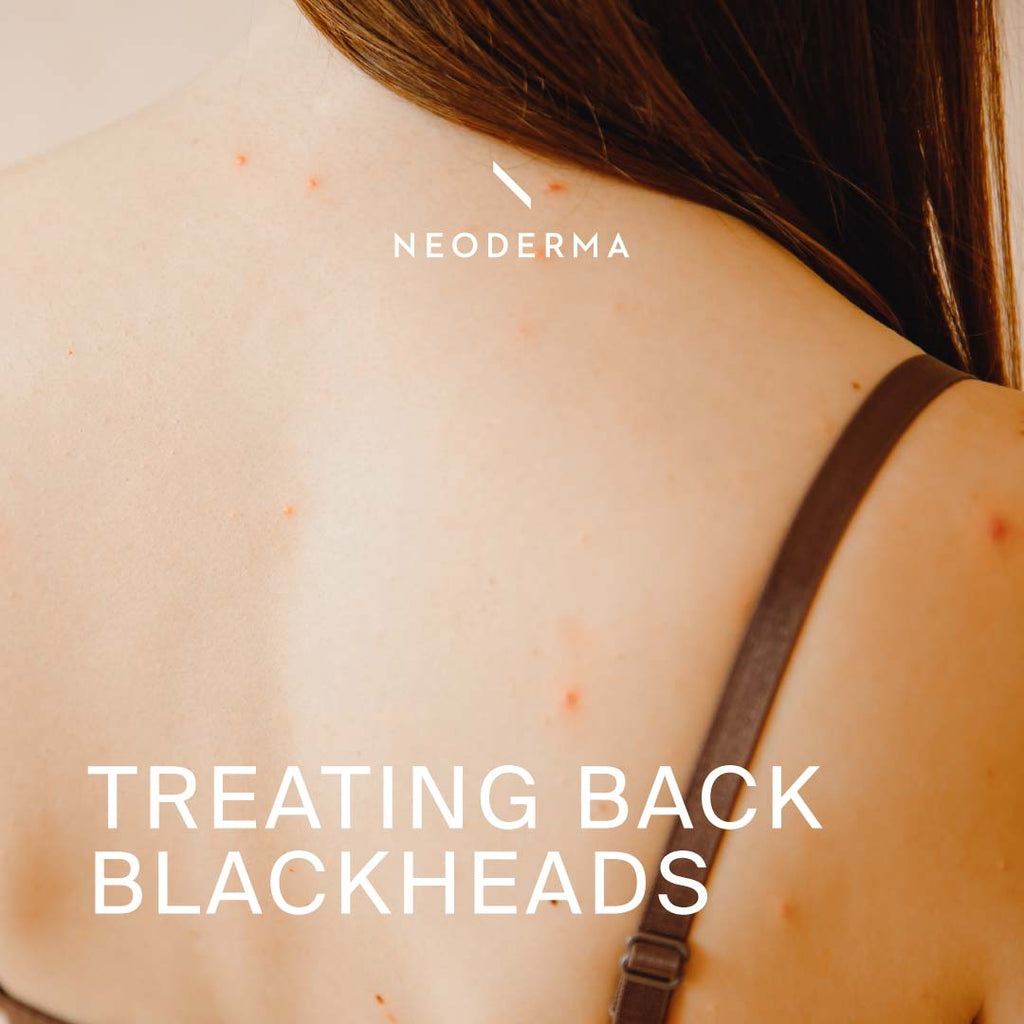 Treating Back Blackheads