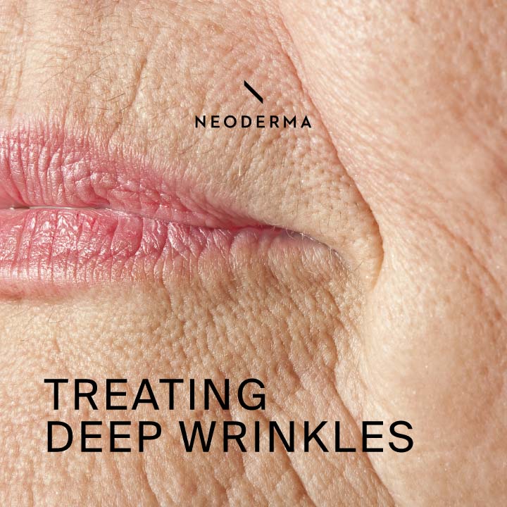 Treating Deep Wrinkles