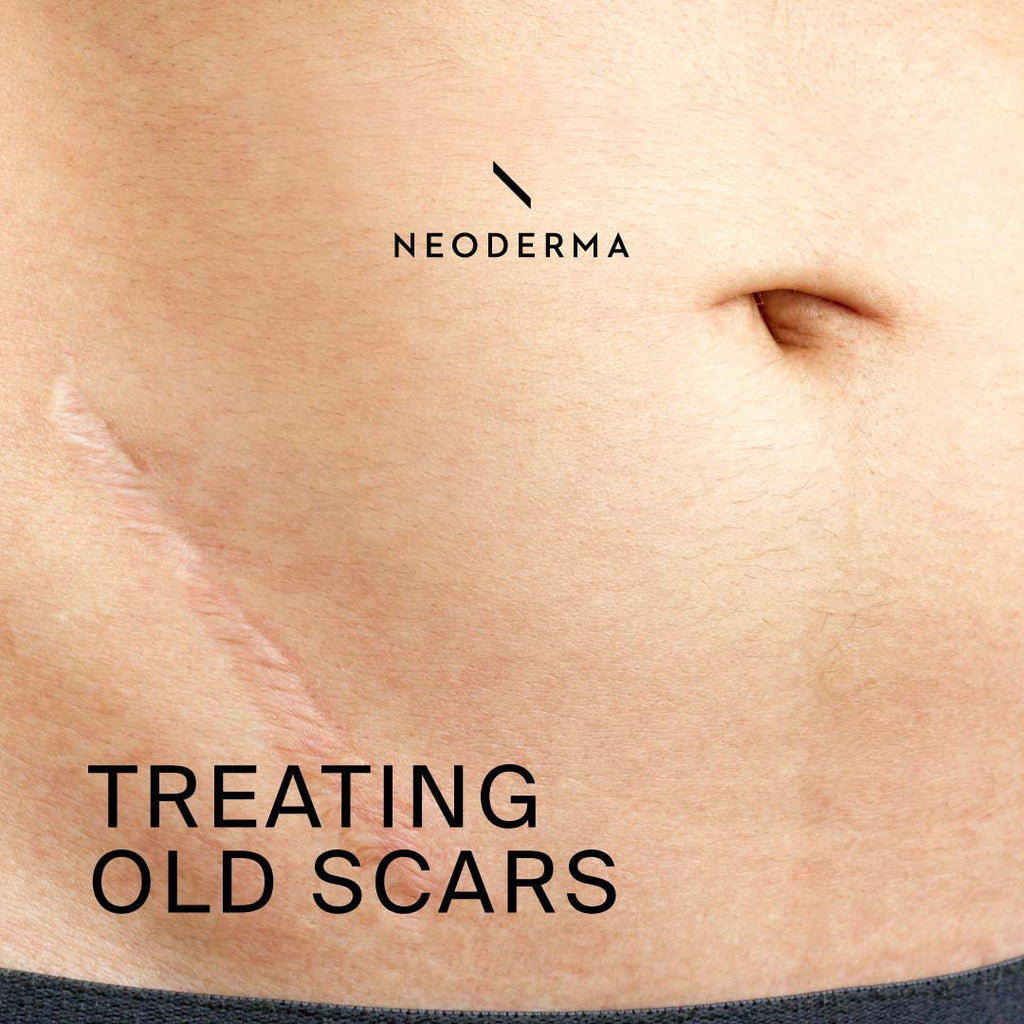 Treating Old Scars