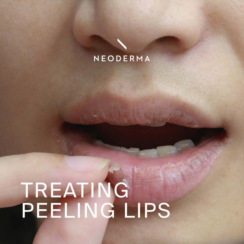 Treating Peelling Lips