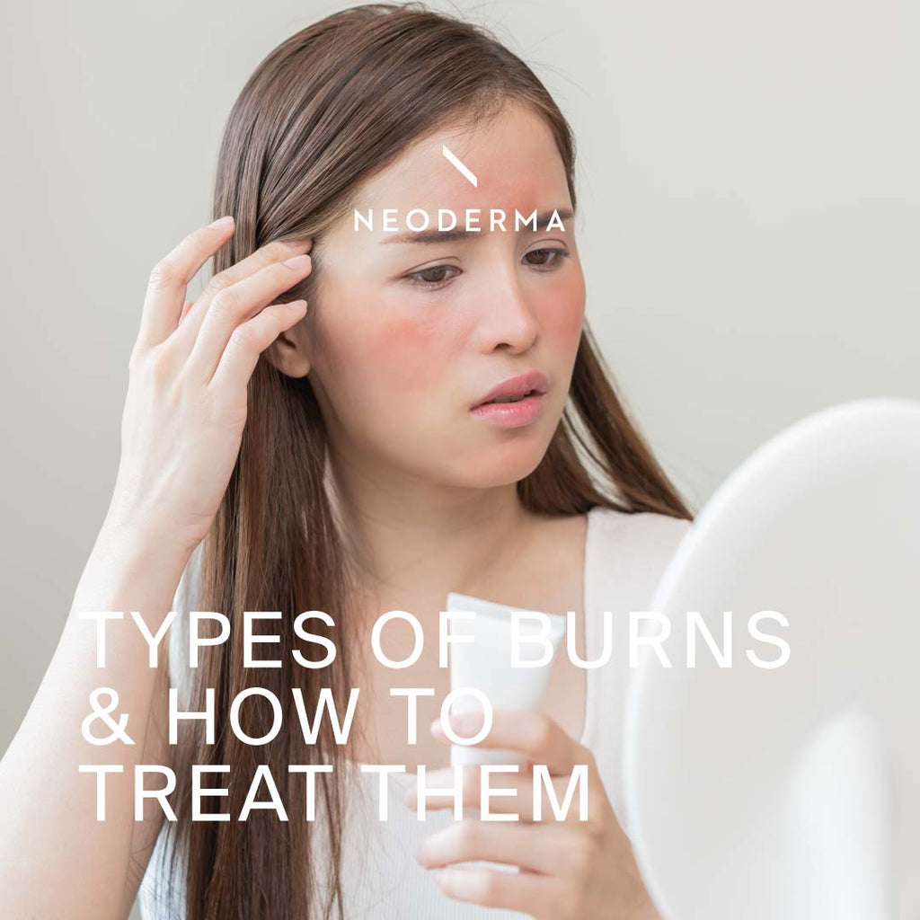 Types of Burns and How to Treat Them