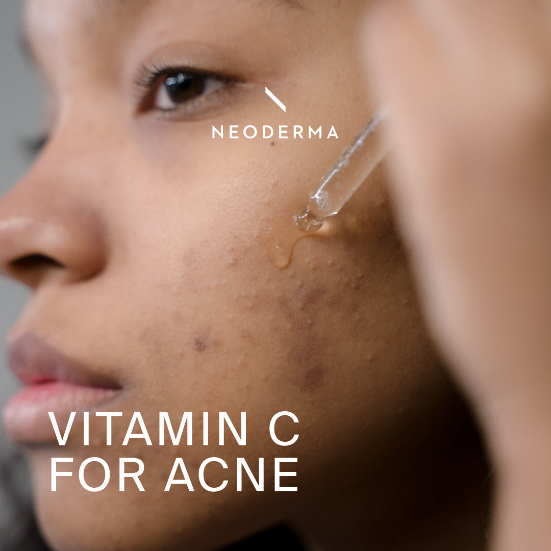 Vitamin C for Acne