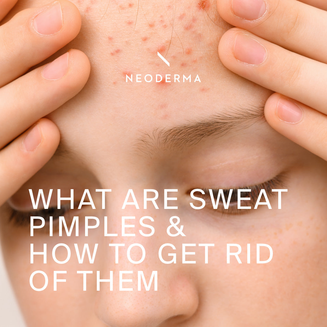 What Are Sweat Pimples & How To Get Rid of Them