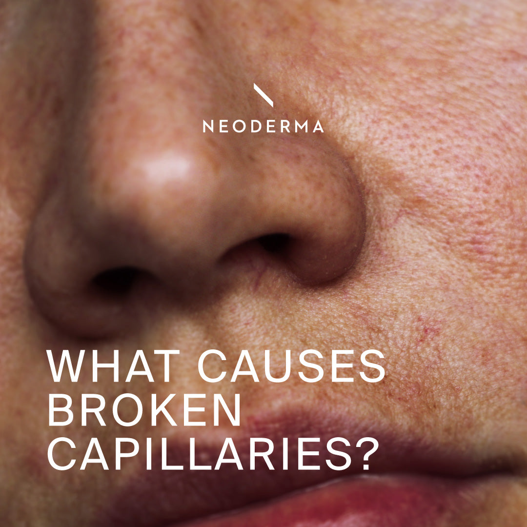 What Causes Broken Capillaries? – NEODERMA