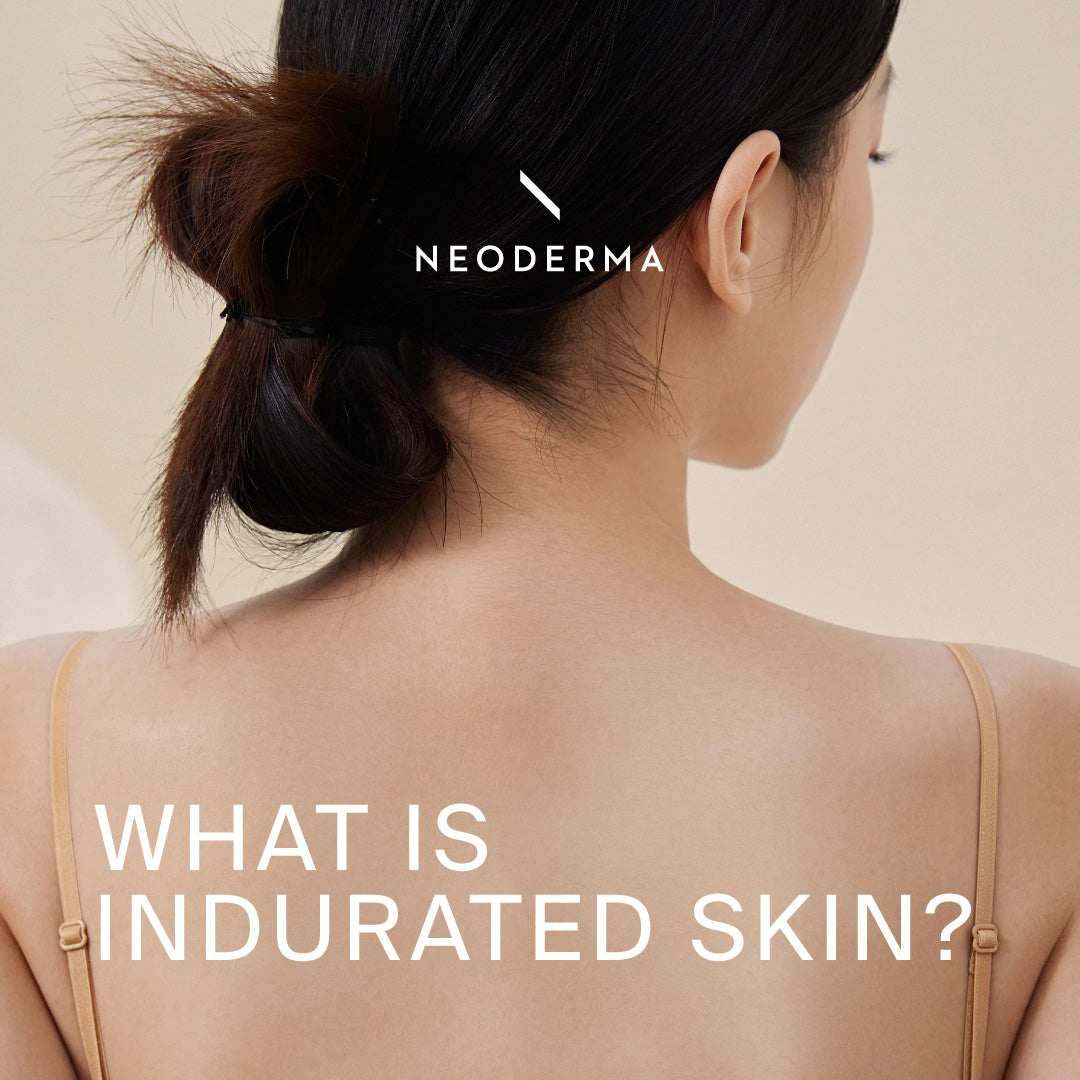 Indurated Incision Oily Skin Face Wash – Gentle Oil‑Control Cleanser for Shine – NEODERMA