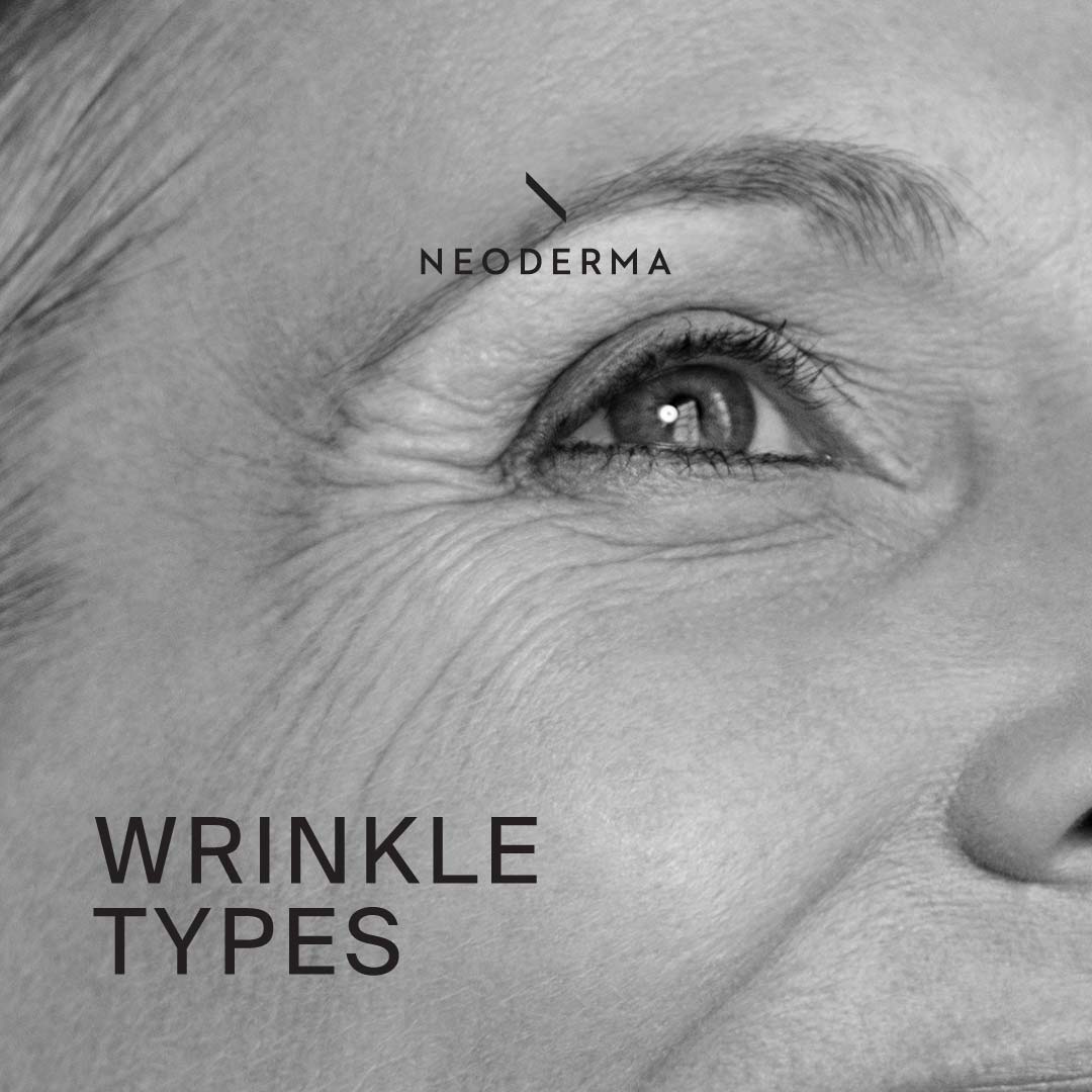Wrinkle Types