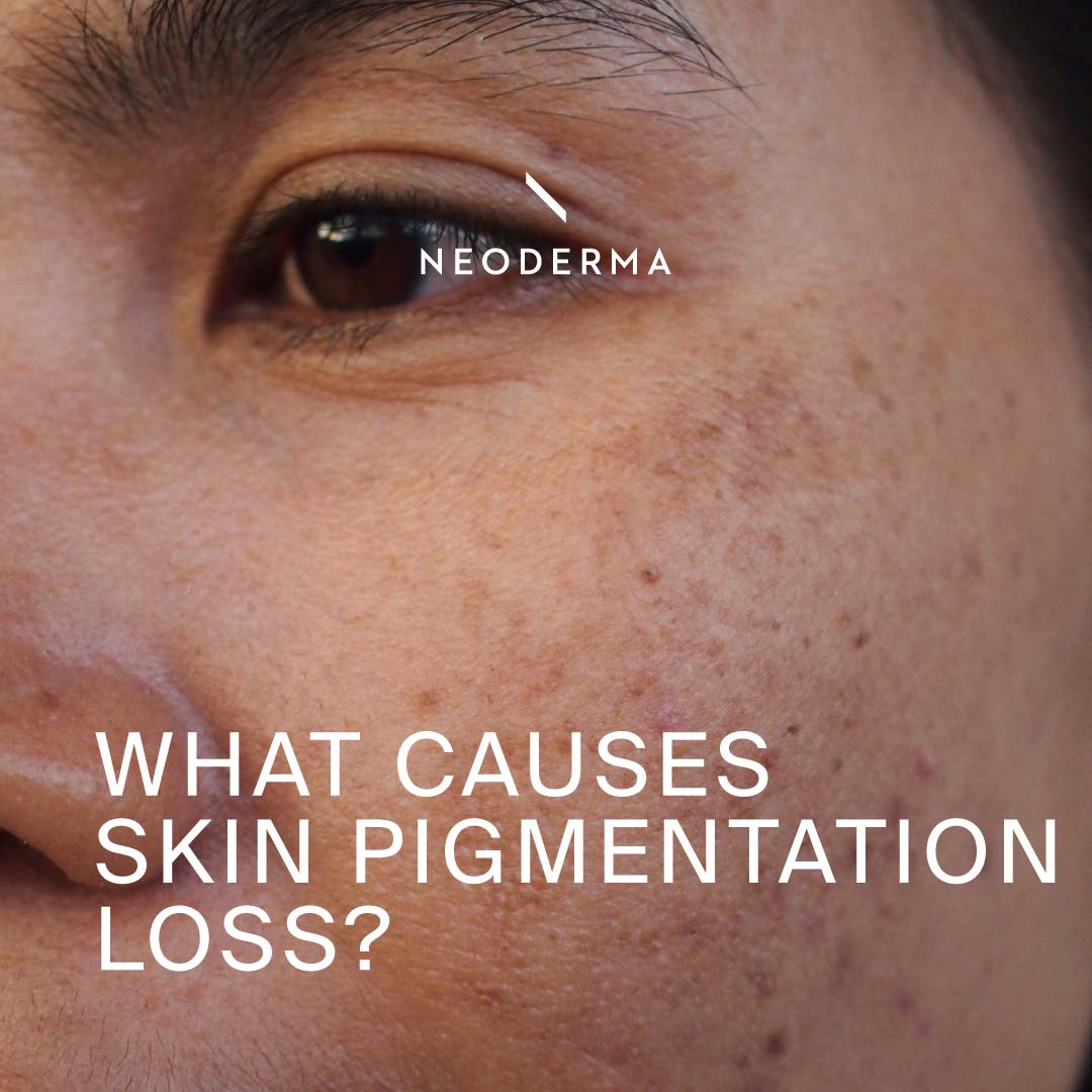 What Causes Skin Pigmentation Loss?