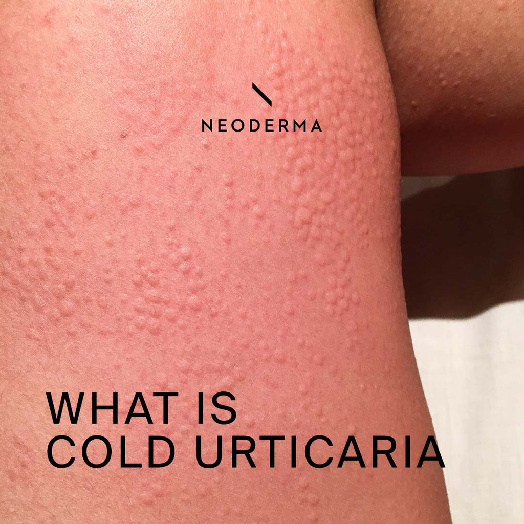 What is Cold Urticaria