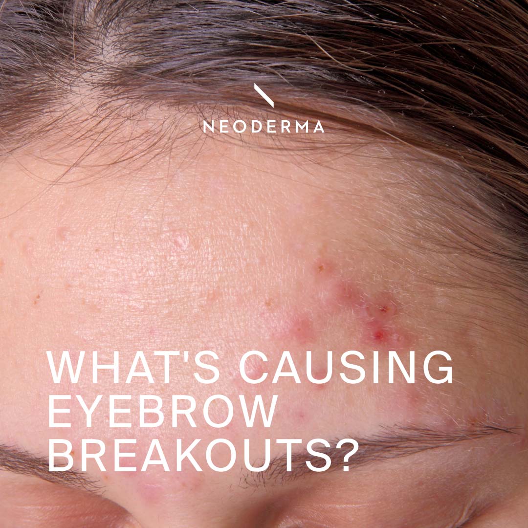What's Causing Eyebrow Breakouts? – NEODERMA