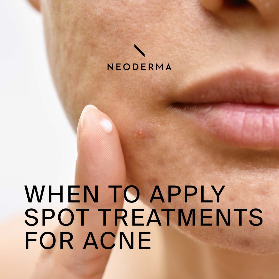 When to Apply Spot Treatments for Acne