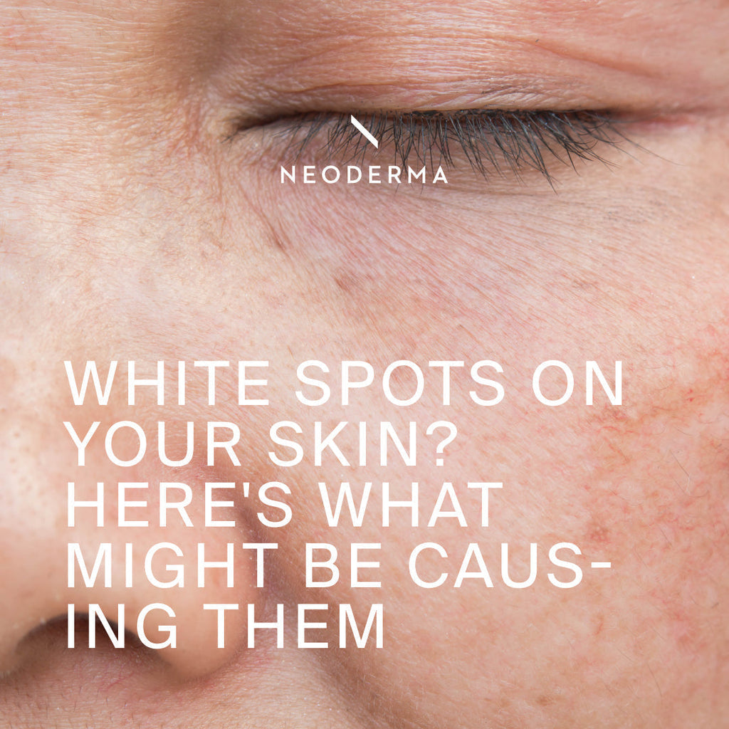 White Spots On Your Skin? Here's What Might Be Causing Them
