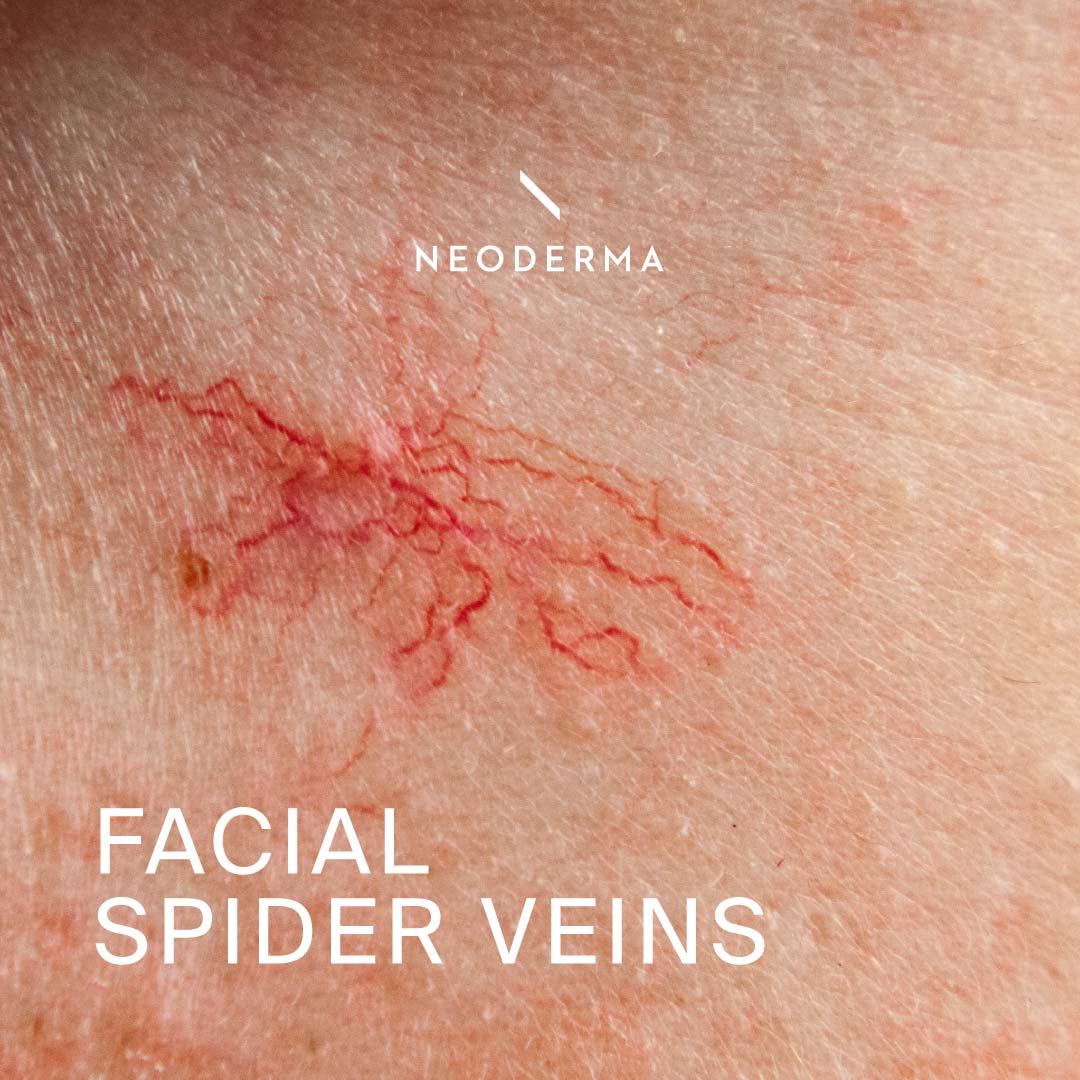 Spider Vei Rash Facial Spider Veins – NEODERMA